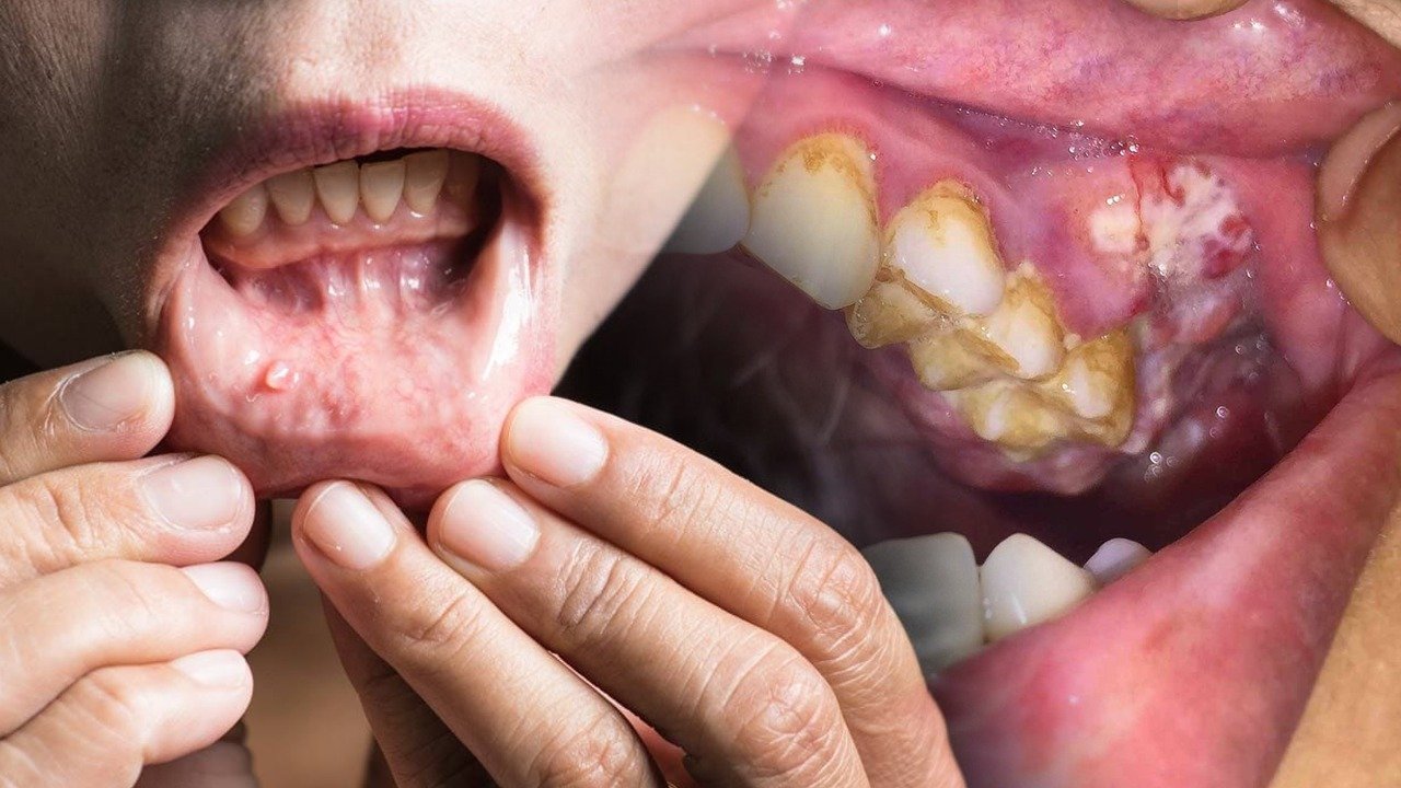 Mouth and Oral Cancer Specialist Doctor in Delhi