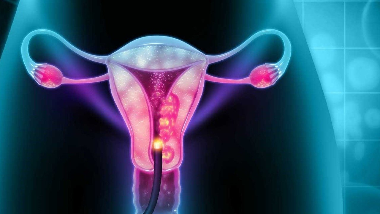 Cervical Cancer Specialist Doctor in Delhi